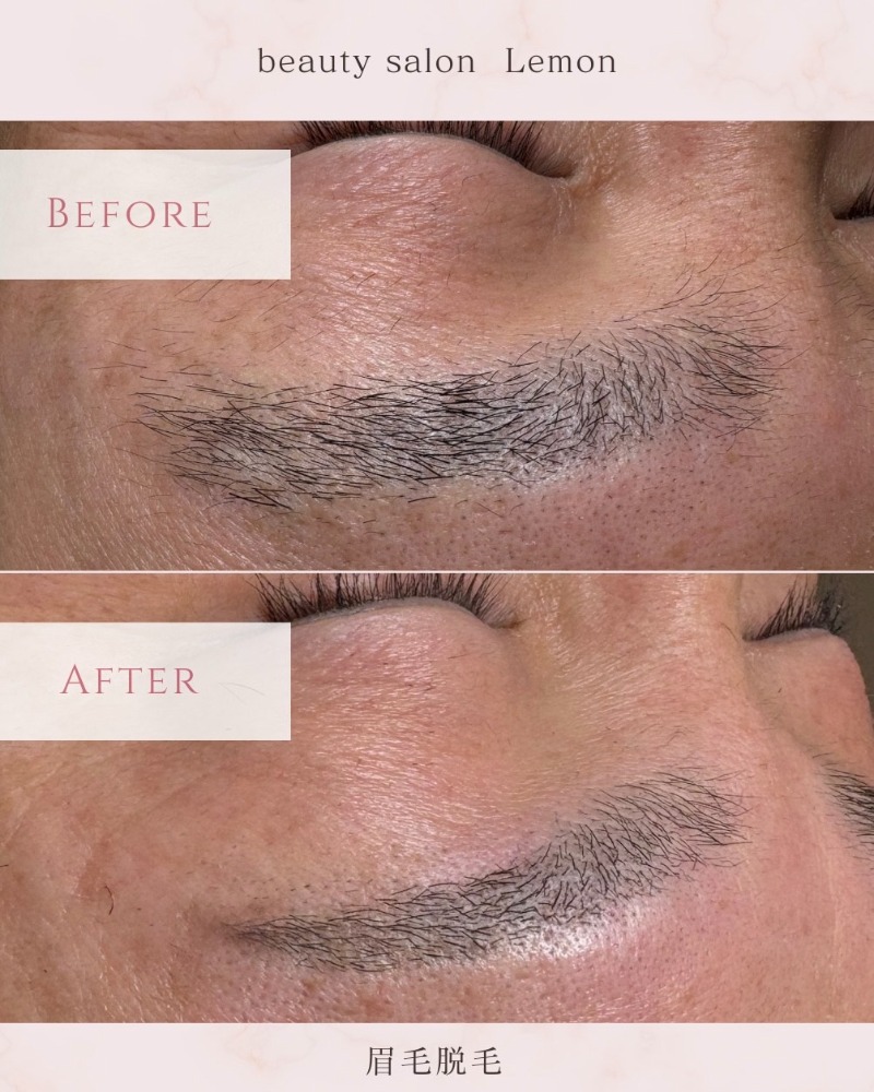 眉毛ニードル脱毛 施術前後